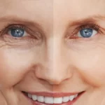 Are Chemical Peels Safe for Older Skin?