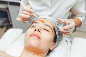 Are Monthly Chemical Peels Good?