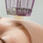 At What Age Should You Start Microneedling?