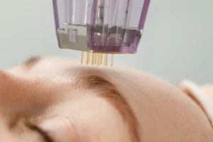 At What Age Should You Start Microneedling?