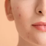 Can Dark Spots Be Removed Naturally?