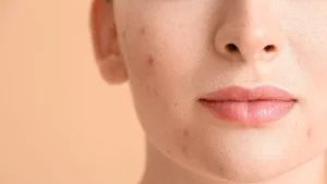Can Dark Spots Be Removed Naturally?