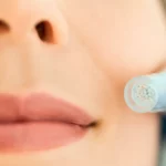 Can You Microneedle Your Lips?
