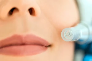 Can You Microneedle Your Lips?