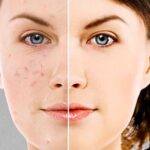 Do Age Spots Grow Back?