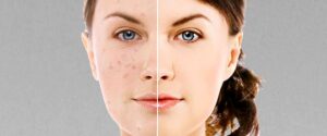 Do Age Spots Grow Back?