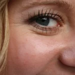 Do Wrinkles Look Worse After Microneedling?