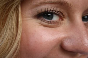 Do Wrinkles Look Worse After Microneedling?