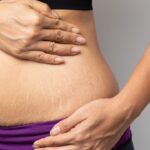 Does Microneedling Work on Stretch Marks?