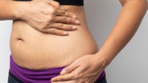 Does Microneedling Work on Stretch Marks?