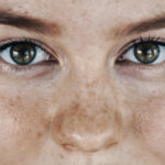 Does Sugar Cause Age Spots?