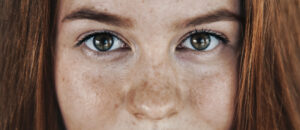 Does Sugar Cause Age Spots?