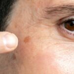 How Do I Get Rid of Age Spots?
