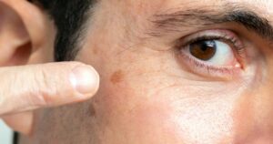 How Do I Get Rid of Age Spots?