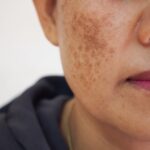 How Do I Know If I Have Sunspots or Melasma?
