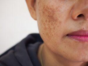 How Do I Know If I Have Sunspots or Melasma?