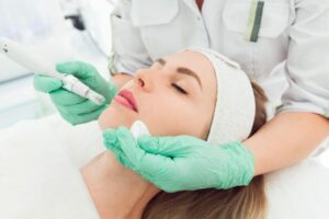 How Do You Maximize Microneedling Results?