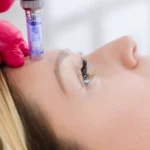 How Long Do Microneedling Results Last?
