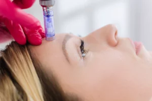 How Long Do Microneedling Results Last?