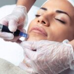 How Long Does it Take to See Full Results from Microneedling?