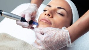 How Long Does it Take to See Full Results from Microneedling?