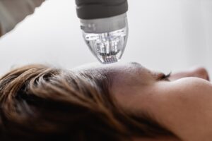 How Long Does Skin Purge After Microneedling?