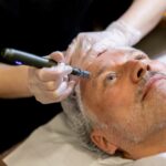 How Painful is Microneedling on Your Face?