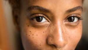 How to Lighten Dark Spots Overnight?