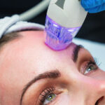 Is Microneedling Actually Good for Your Skin?