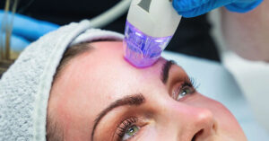 Is Microneedling Actually Good for Your Skin?