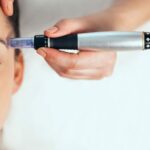 What is Microneedling Good for?