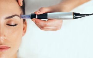 What is Microneedling Good for?
