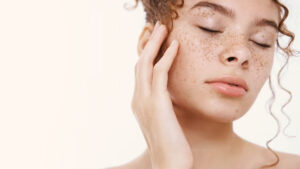 Should You Remove Age Spots?