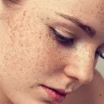 What Age Do You Start Getting Sunspots?