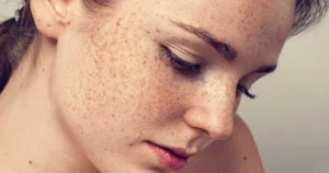 What Age Do You Start Getting Sunspots?
