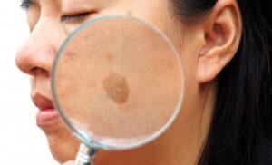 What Can Be Mistaken for Age Spots?
