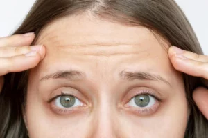 What Chemical Peel Gets Rid of Wrinkles?