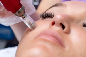 What Do Dermatologists Say About Microneedling?