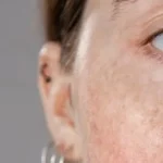 What Does It Mean When an Age Spot Turns Red?