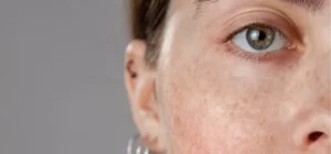 What Does It Mean When an Age Spot Turns Red?