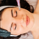 What Does Your Face Look Like After Microneedling?