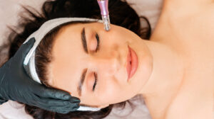 What Does Your Face Look Like After Microneedling?