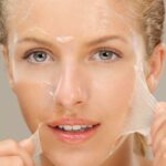 What is a No-Downtime Chemical Peel?