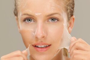 What is a No-Downtime Chemical Peel?