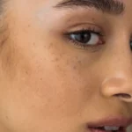 What Is the Fastest Way to Fade Dark Spots?