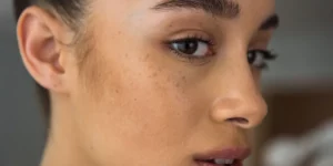 What Is the Fastest Way to Fade Dark Spots?