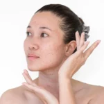What Is the Main Cause of Age Spots?