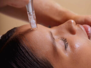 When Does Collagen Peak After Microneedling?