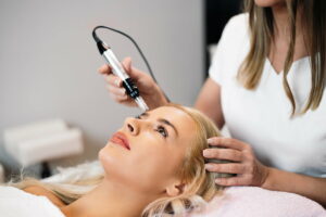 Where is Microneedling Most Effective?
