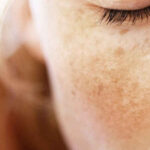 Which Chemical Is Best for Dark Spots?